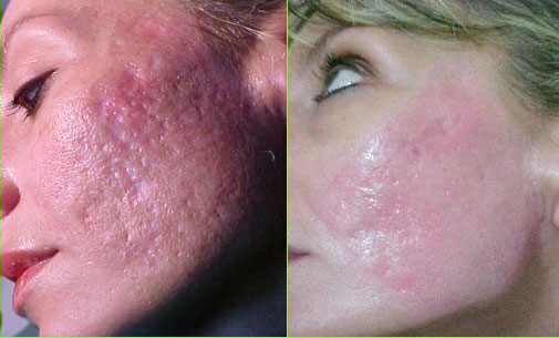 steroid acne