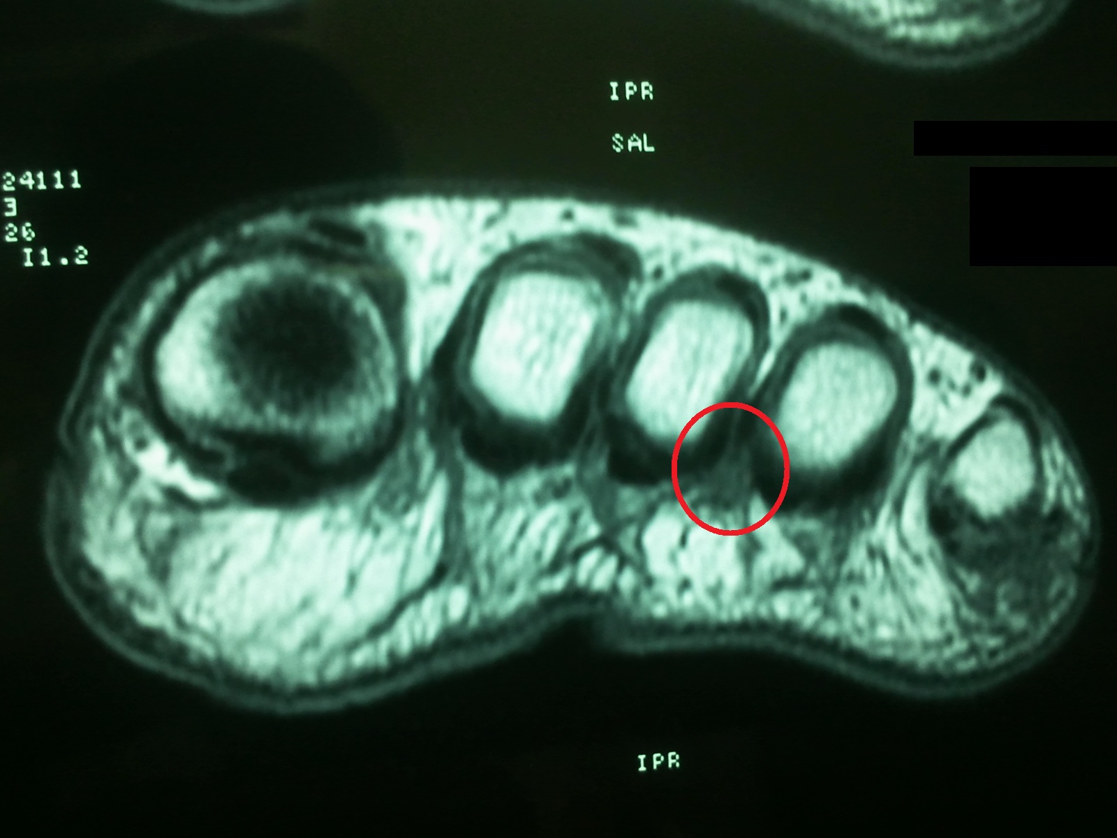 interdigital neuroma