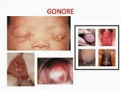 Cara Mengobati Penyakit Gonore Secara Alami Cara Mengobati Penyakit Gonore Secara Alami