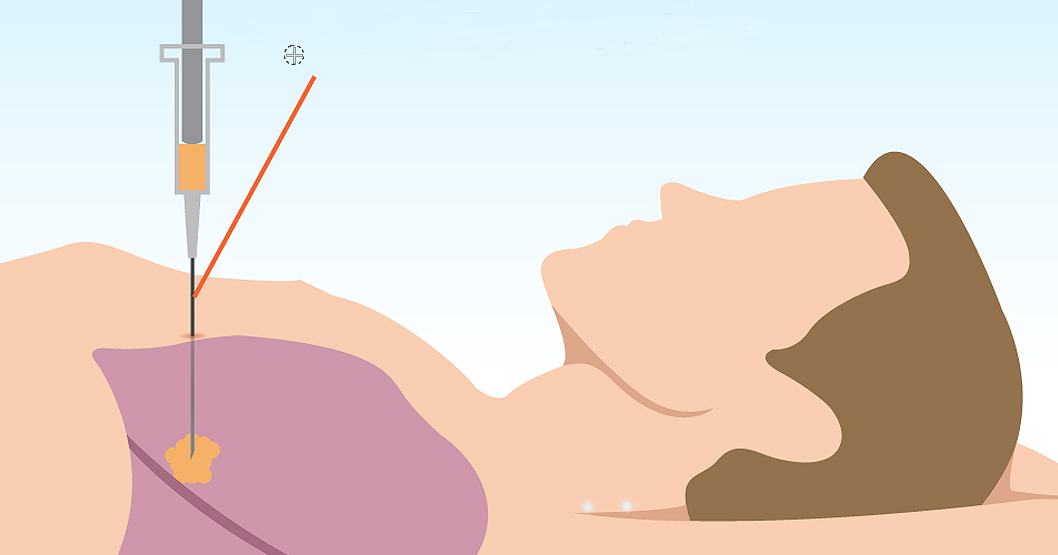 DrRattawachIR การเจาะปอดผ่านทางผิวหนัง (Transthoracic Needle Biopsy)