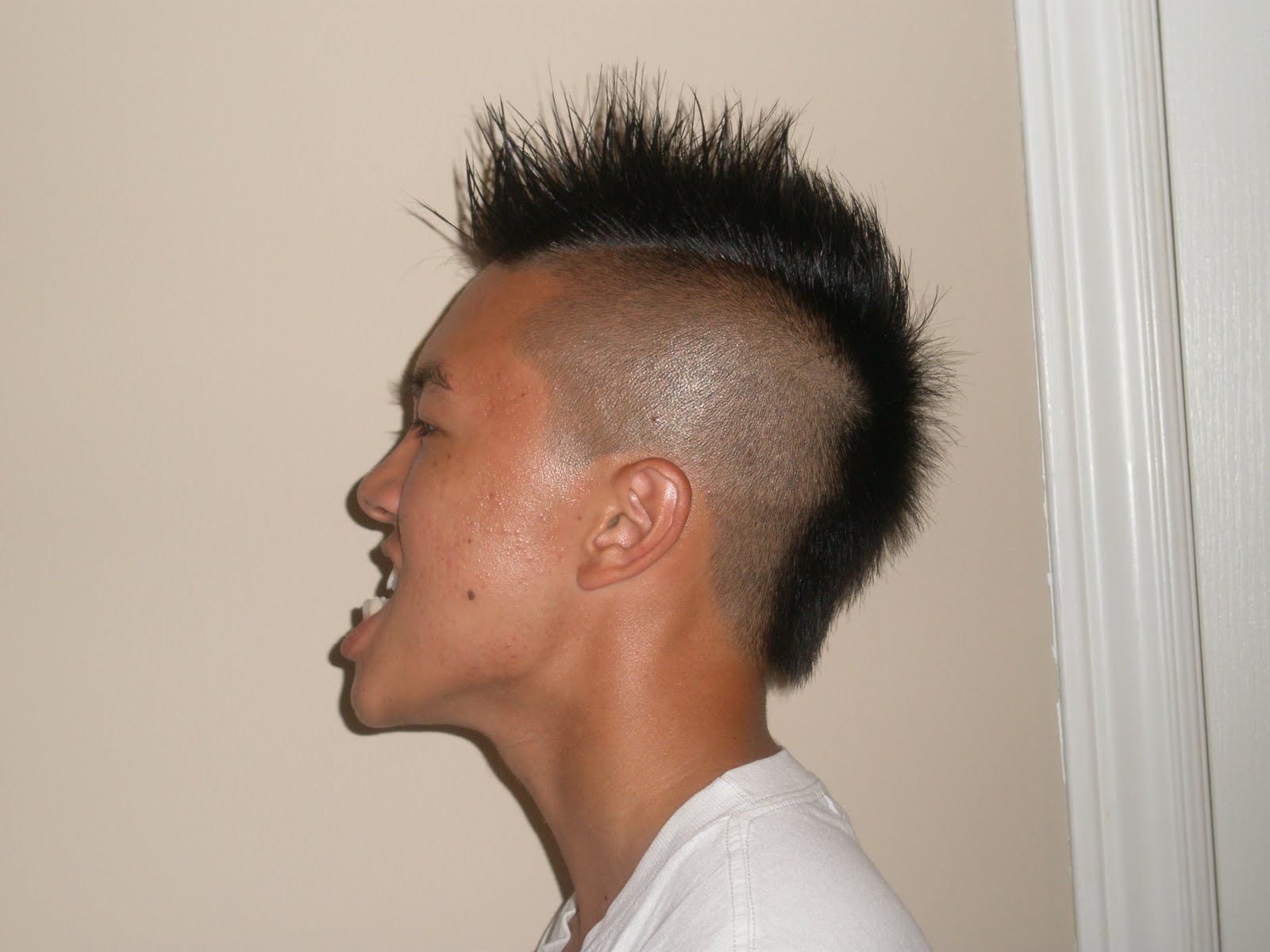 Gordon's Double Jaw Surgery "You look different" Day 59 (July 6)