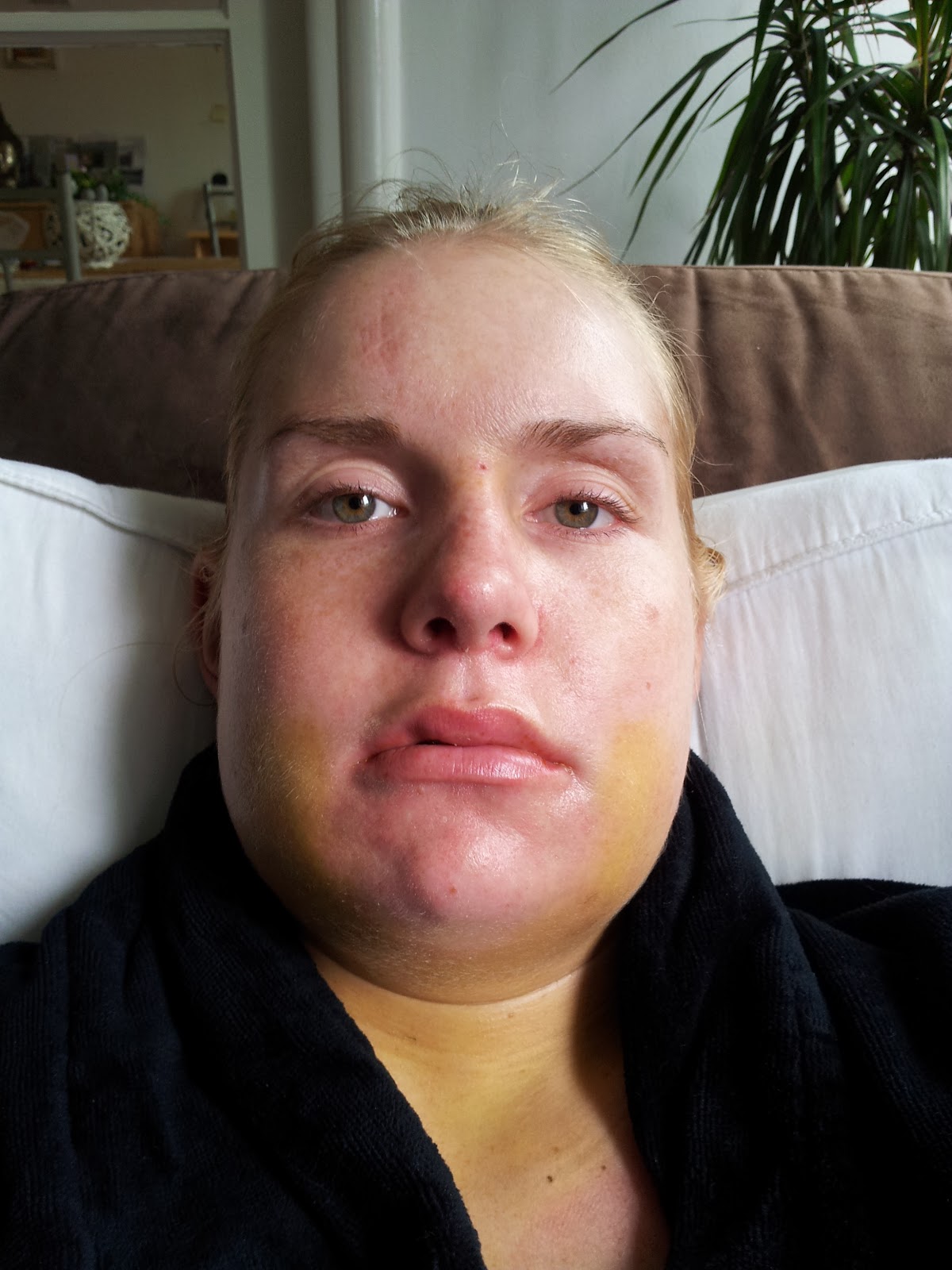 blauwe plek in gezicht