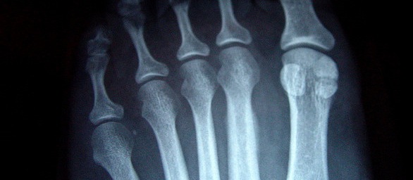 Arthritis foot septic radiopaedia Nashville Podiatrists: The Nashville Foot and Ankle Group: Heel Pain