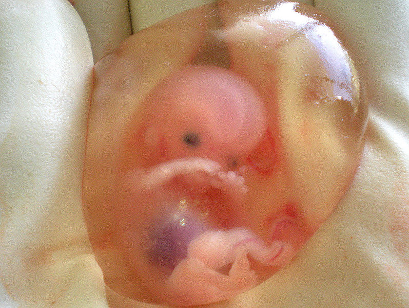 of a 10 week aborted baby