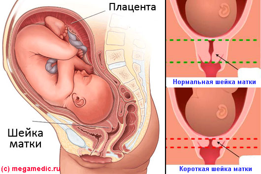 Какая Матка При Беременности Фото