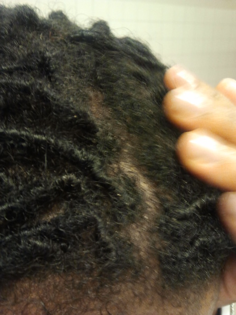 buildup on scalp