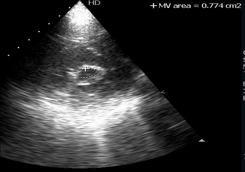Phimaimedicine 1,126. Mitral stenosis chest film