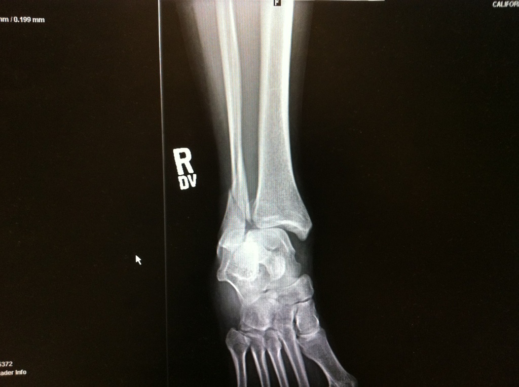 My Broken Ankle =( ER Broken ankle, fractured heel, dislocated, and