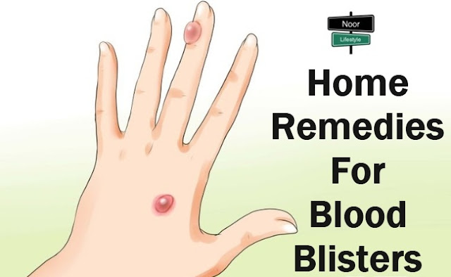 Small Blood Blisters On Skin Wallpapers Download 5