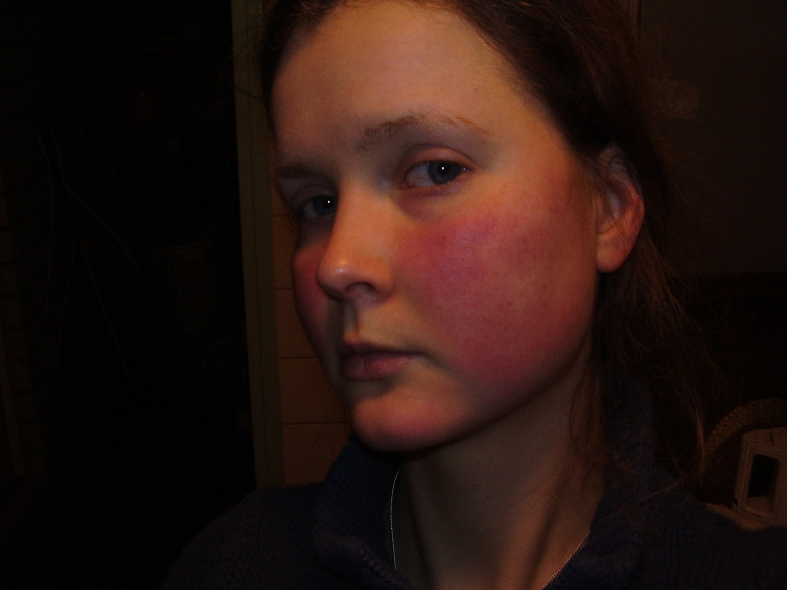 Scarlet Letters, dealing with vascular rosacea, face flushing, burning