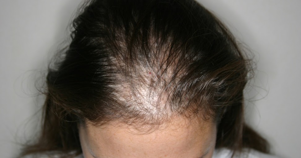 what cause hair loss: Can women hair loss makes me totally ... alopecia female diagram 