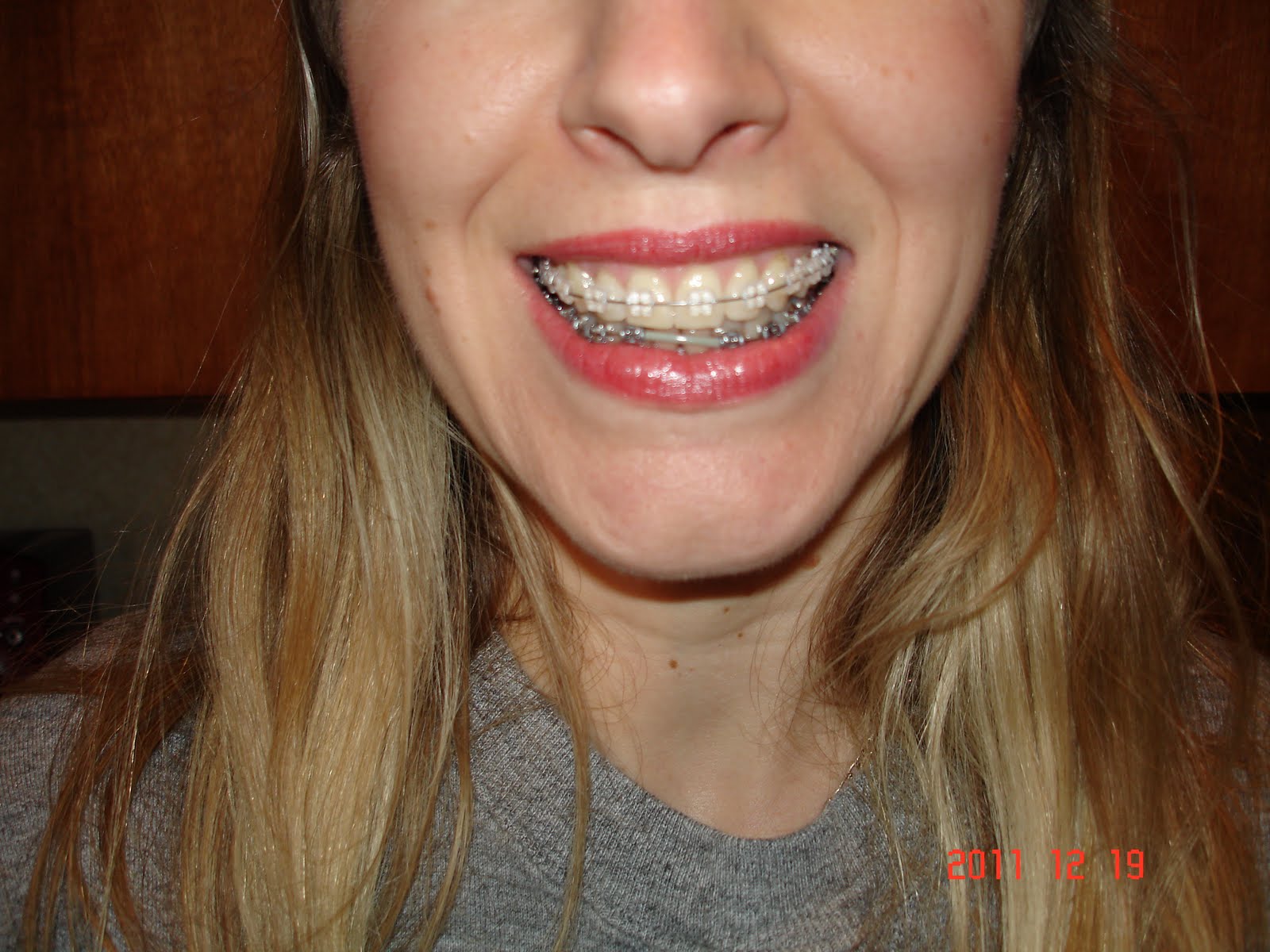 Amy's Adventure With Braces Before and After Pics