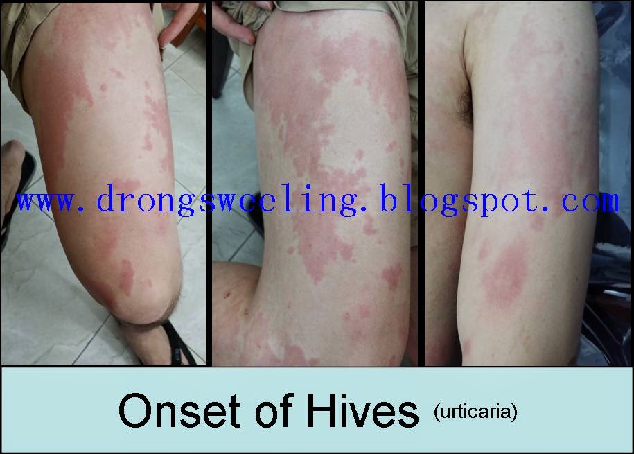 TCM News Can TCM Chinese Doctor Cure Hives