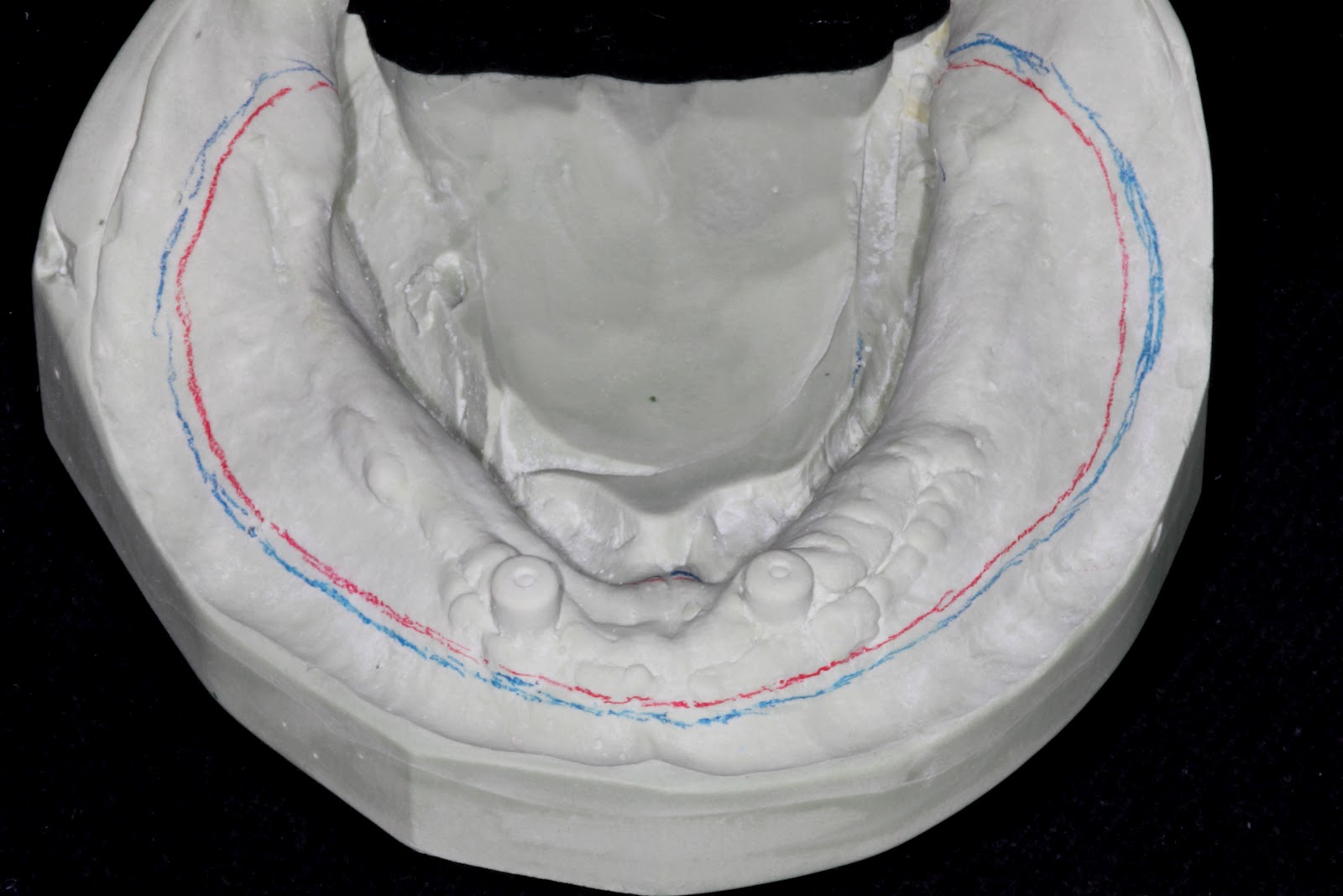 Boise Idaho Prosthodontics Edentulous Custom Tray for PVS Impression