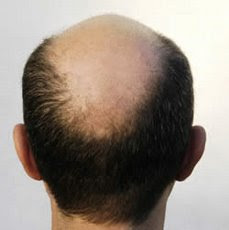 male baldness