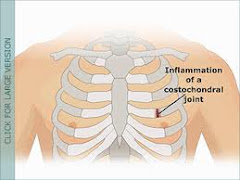 Costochondral