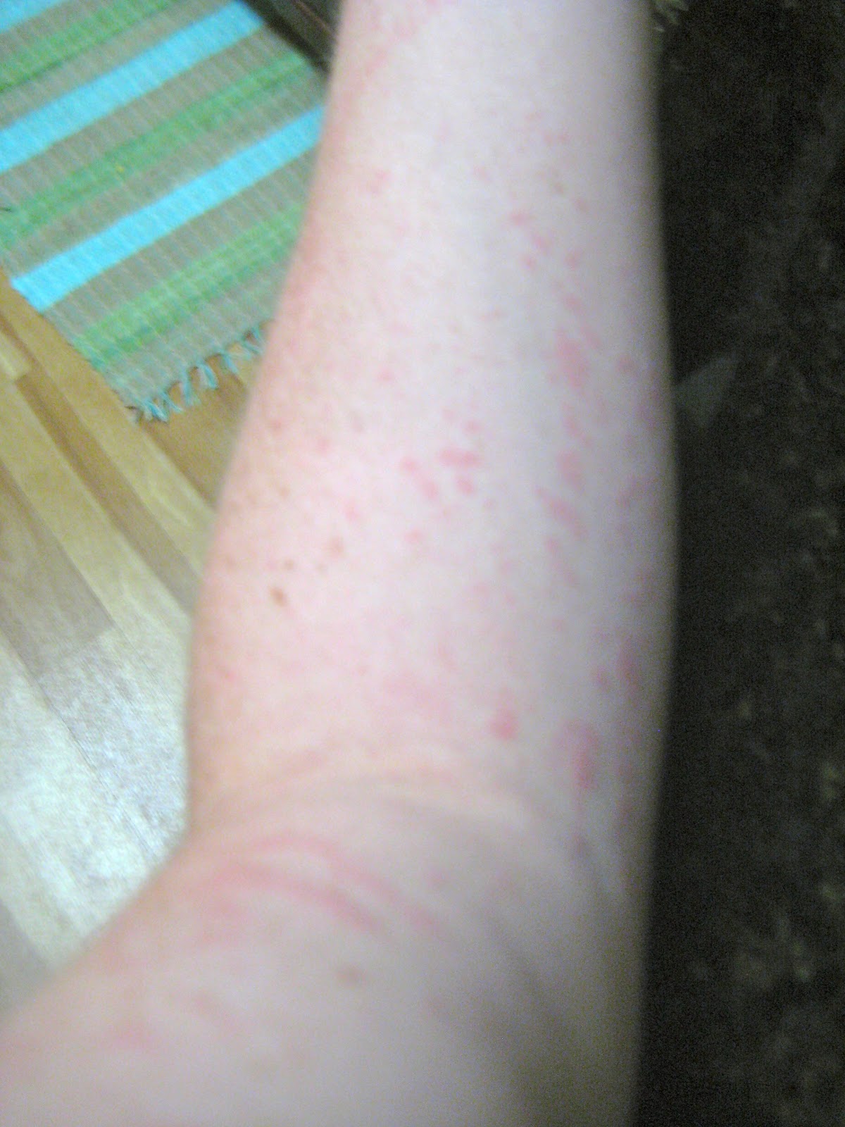 Me, Myself, and Still's Disease May 2012