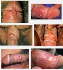 obat sipilis sipilis pria, sipilis wanita, sipilis laten, sipilis parah, obat sipilis