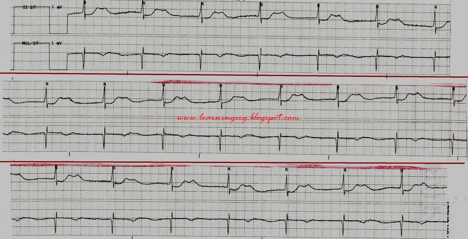ECG Rhythms Pseudofirst degree AV block