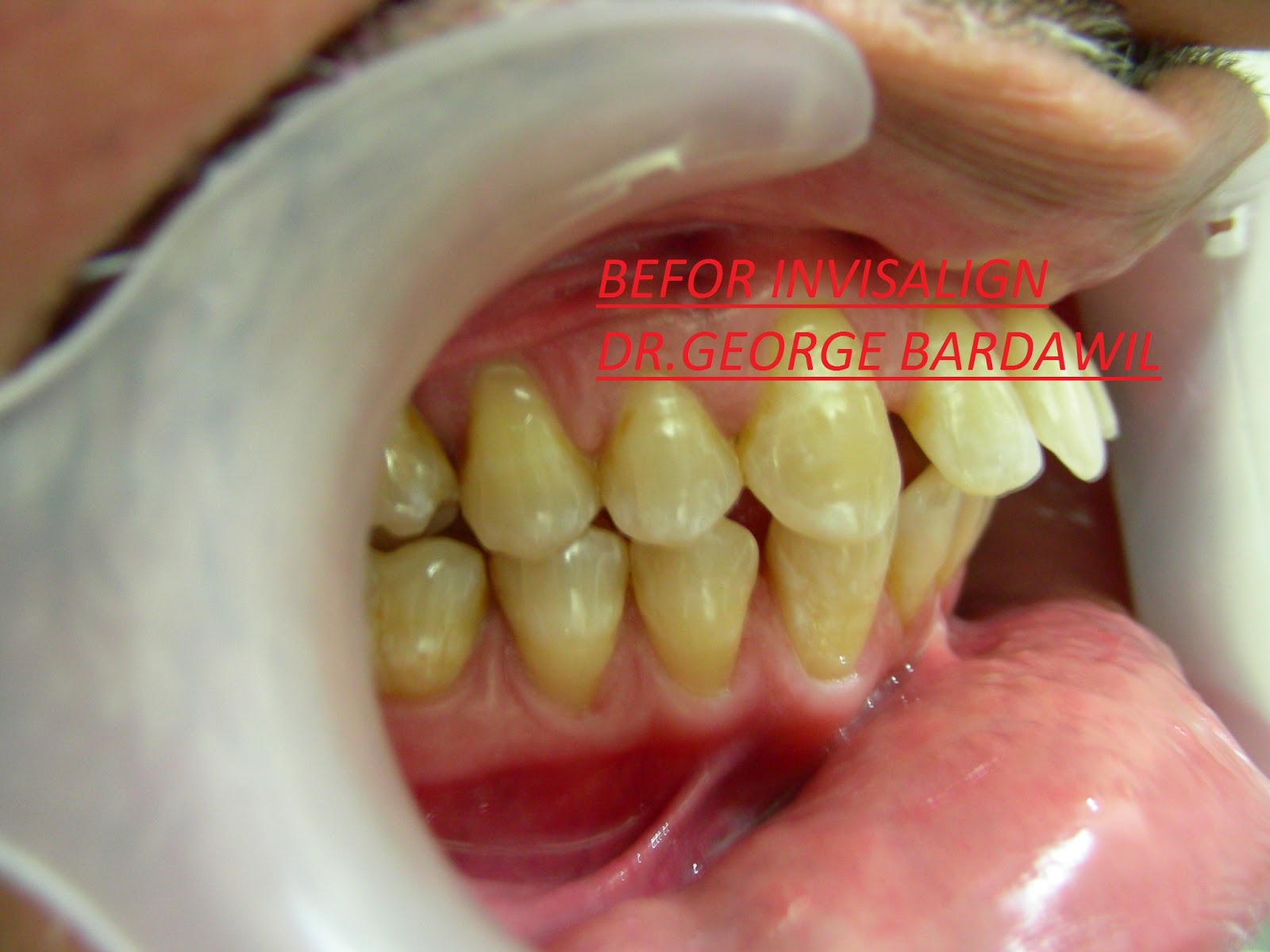 E. BardawilOrthodontistInvisalign Diamond level