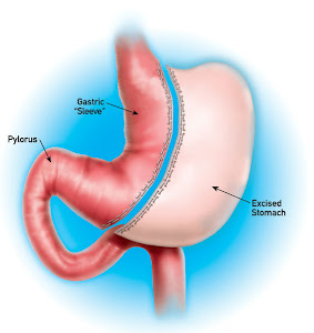 Vertical Sleeve Gastrectomy (gastric sleeve)