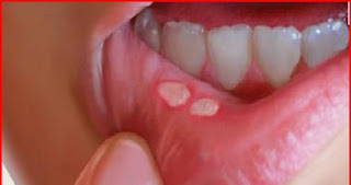 http://mummydinashoppe.blogspot.com/2012/12/sakitnya-ulcer-mulut.html