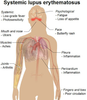Penyakit Lupus Jenis Gejala