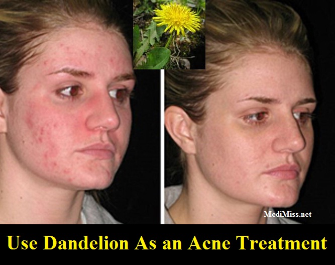 Home Remedies Dandelion Killer Home Remedies Dandelion Killer