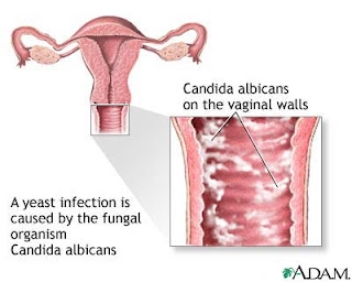 yeast infection is first and foremost an internal problem like most chronic conditions there is never one cause for this fungal problem and thus yeast