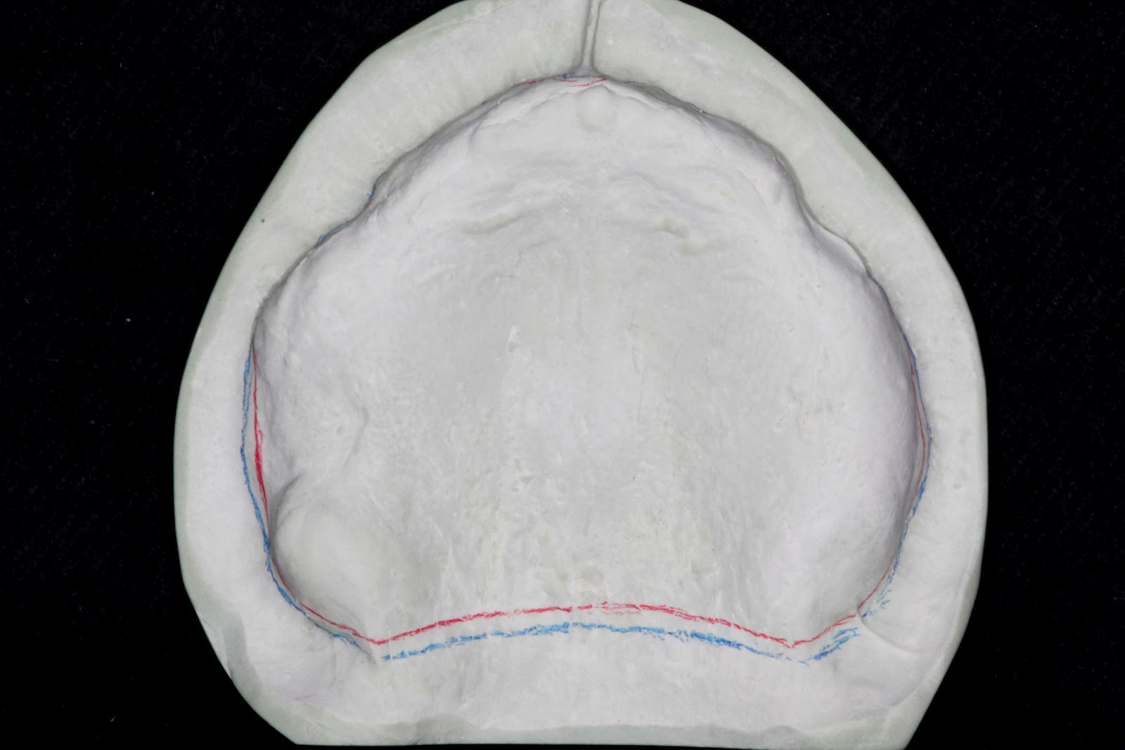 Boise Idaho Prosthodontics Edentulous Custom Tray for PVS Impression Fabrication