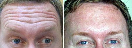 Natural Ways To Decrease Forehead Wrinkles Natural Ways To Decrease Forehead Wrinkles