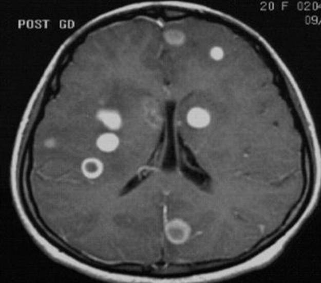 mri hersenen ms