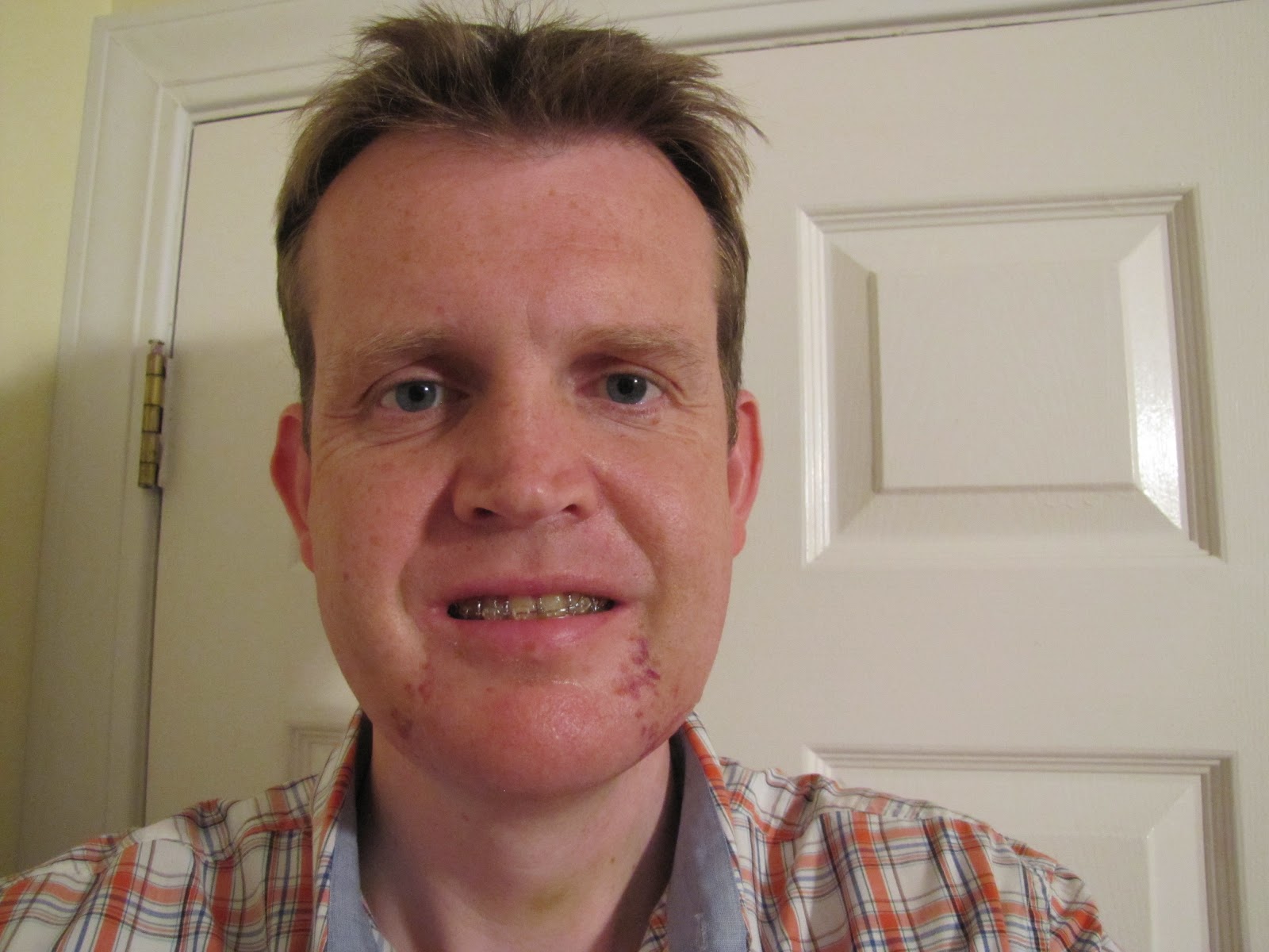 Double Jaw Operation The Road to Recovery