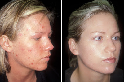 Laser Acne Treatment Before and After