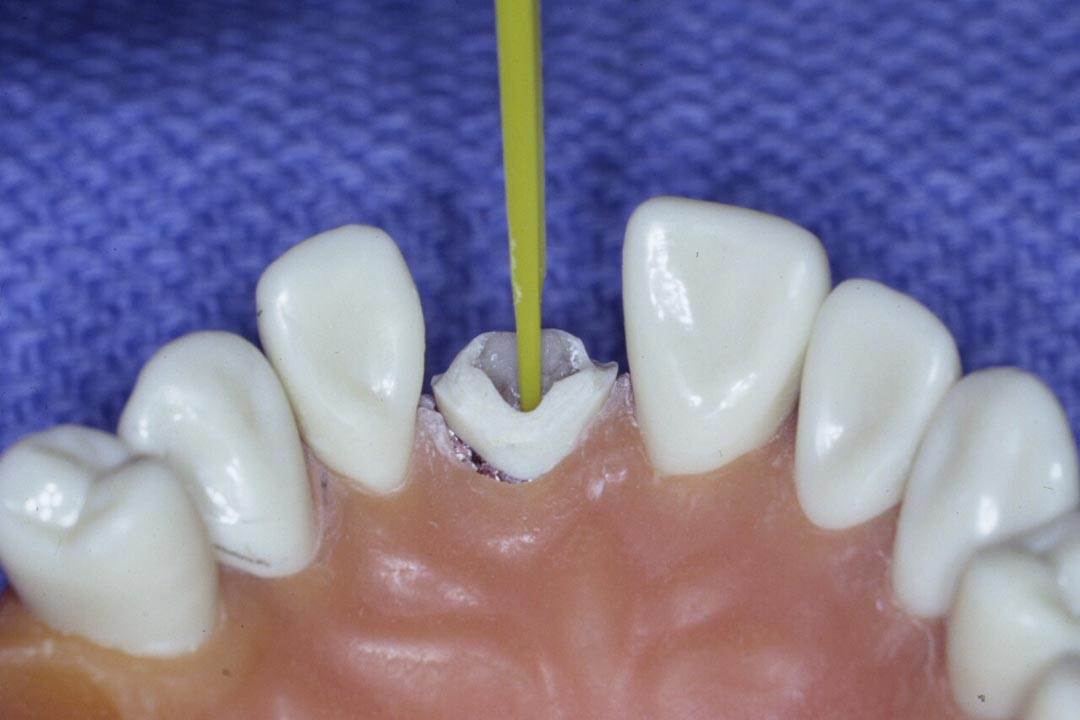 Dentistry Custom Cast Dowel Core