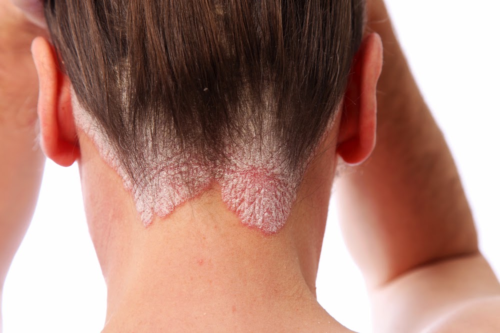 Quien de los actores estaba enfermo de la psoriasis