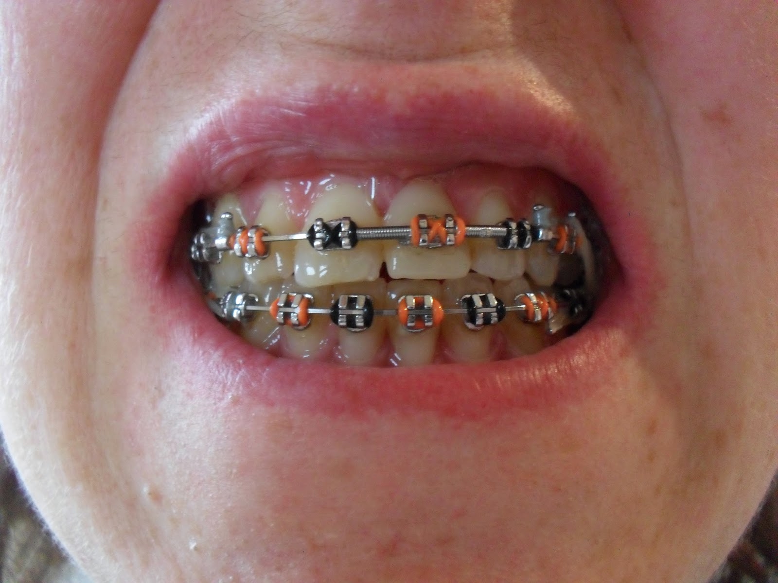 braces jaw fay bsso surgery journey thought compare pre fun