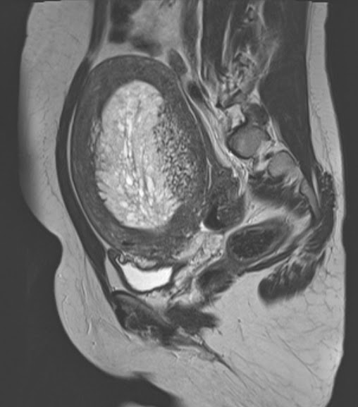 mricases: Endometrial Hyperplasia - MRI