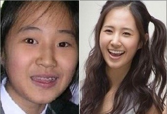 Netizen Buzz Pann Stars Who Fixed Their Teeth