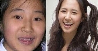 Netizen Buzz Pann Stars Who Fixed Their Teeth