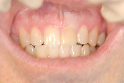 front tooth root canal