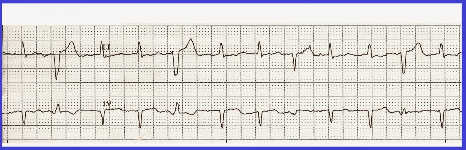 Float Nurse Practice EKG Rhythm Strips 230