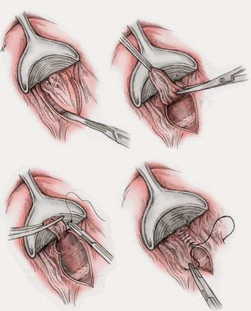 Một số phương pháp phẫu thuật cắt trĩ được áp dụng hiện nay