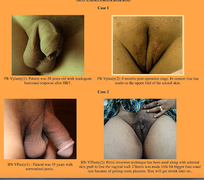 male to female vaginoplasty photos