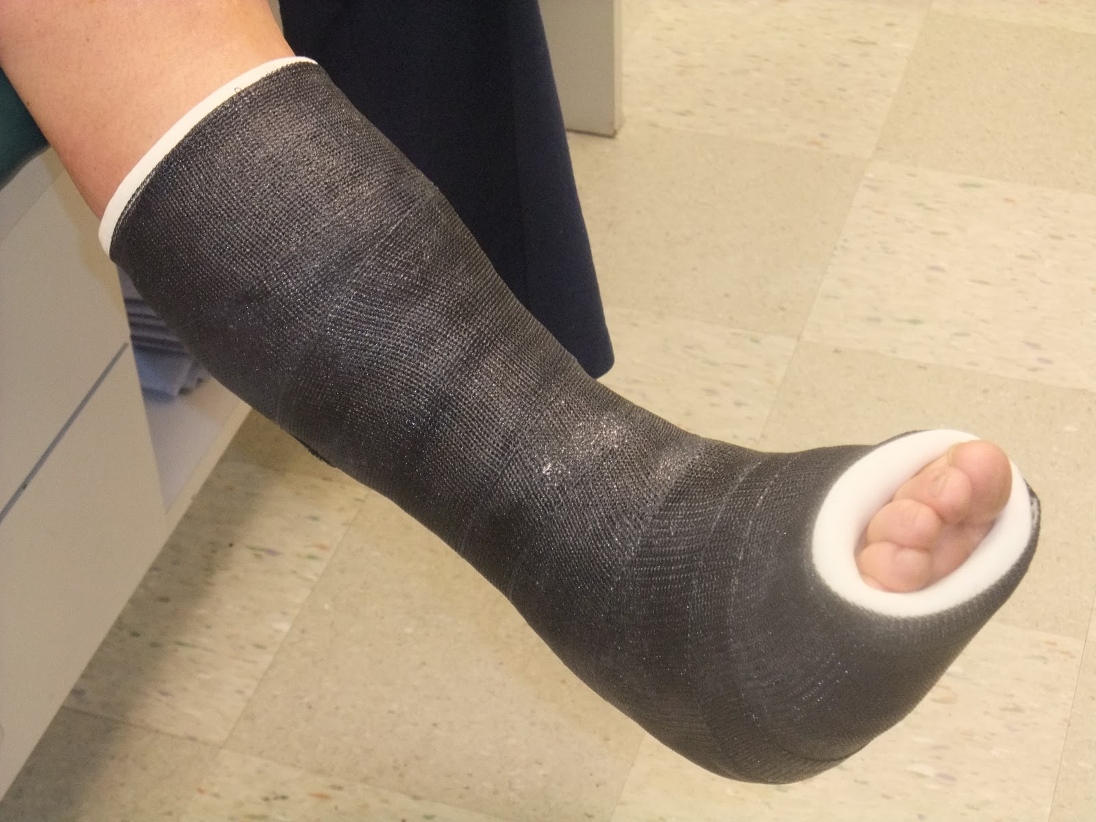 Ankle surgery adventure Cast on and good news!