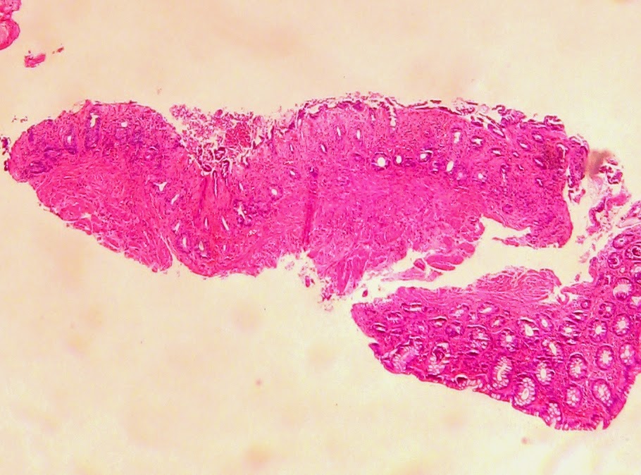 GASTROINTESTINAL AND LIVER HISTOLOGY PATHOLOGY ATLAS COLON ISCHEMIC