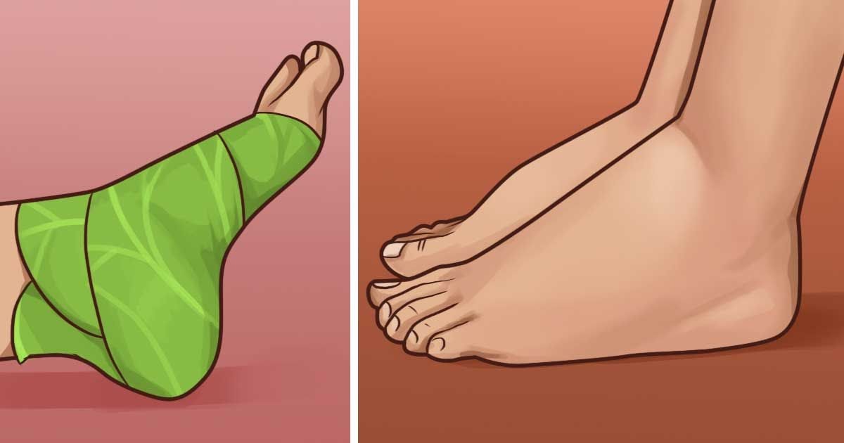How to Treat Swollen Feet forecast How to Treat Swollen Feet advise