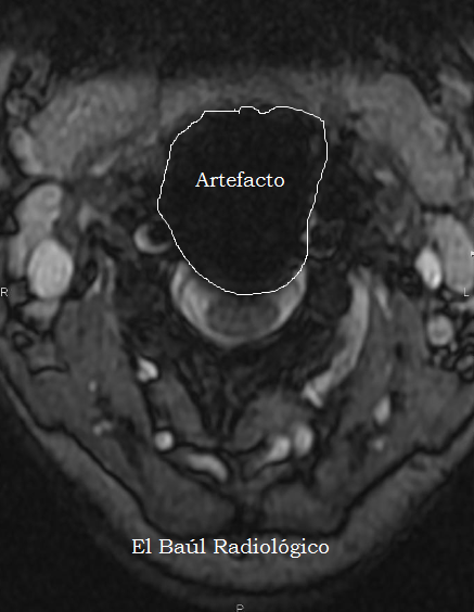 Artrodesis+cervical+4.png