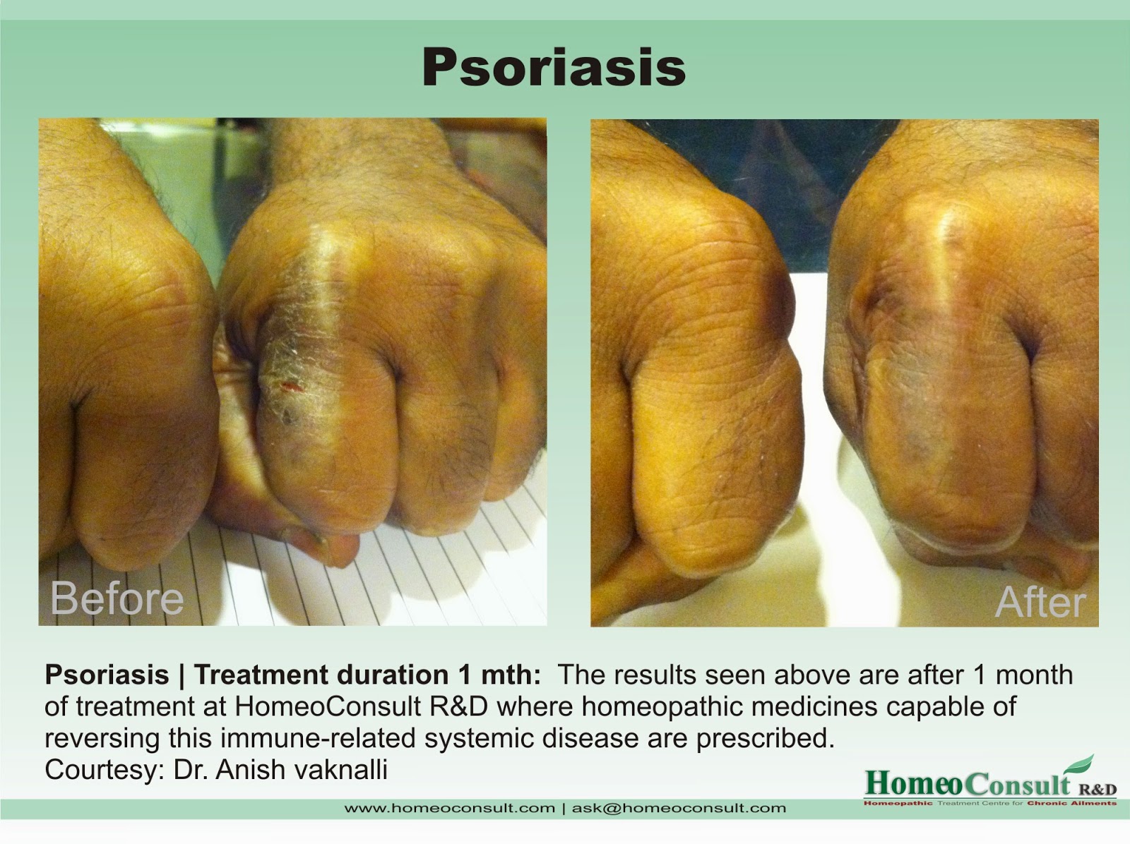 HomeoConsult RD Psoriasis homeopathy treatment and cure