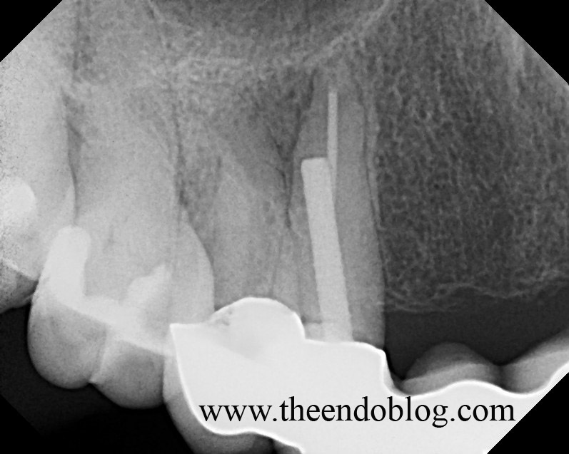 The Endo Blog Root Canal Surgery to Repair Post Perforation